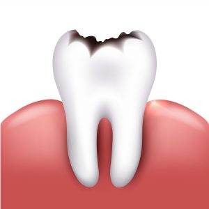 Tooth decay prevention treatment