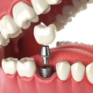 Implants treatment