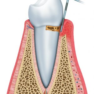 Periodontal treatment